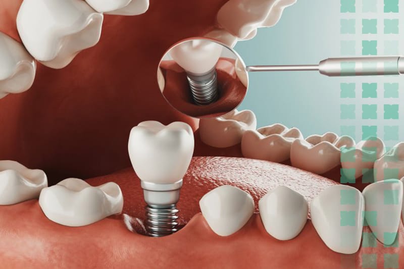 Computer-guided dental implants in Al Ain