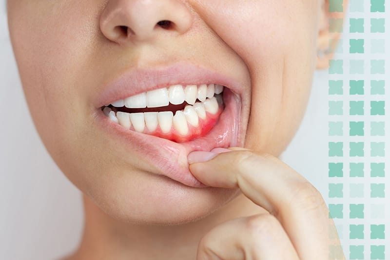 Advanced gum surgery in Al Ain